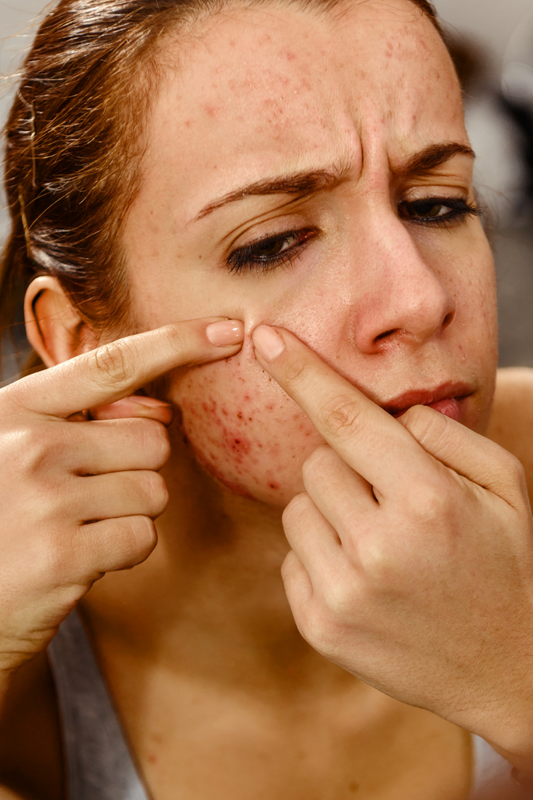Battling Cystic Acne: Tips and Tricks for Clearer skin