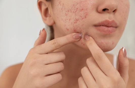 Why Acnea Stands Out: Choosing Us Over Other Skincare Brands