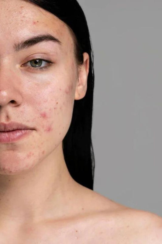 The No‑BS Acne Guide: How to Get Clear Skin Without the 12‑Step Routine