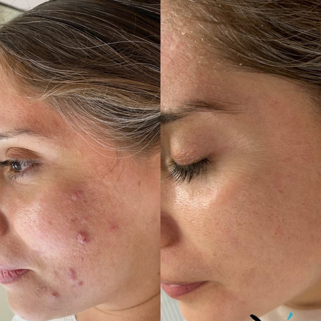 Sensitive Skin Acne Spot Cream