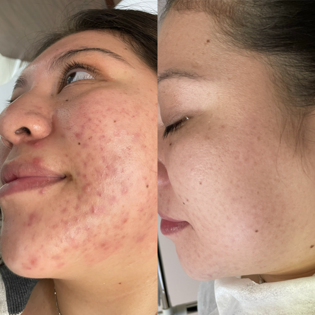 Acne Sensitive Cleanser