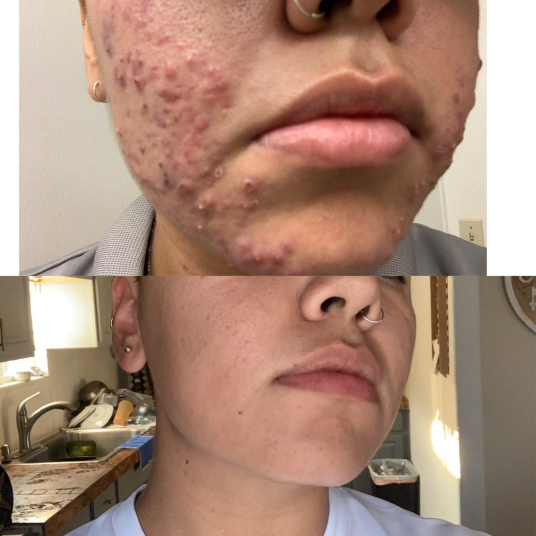 No.Two Acne Spot Cream