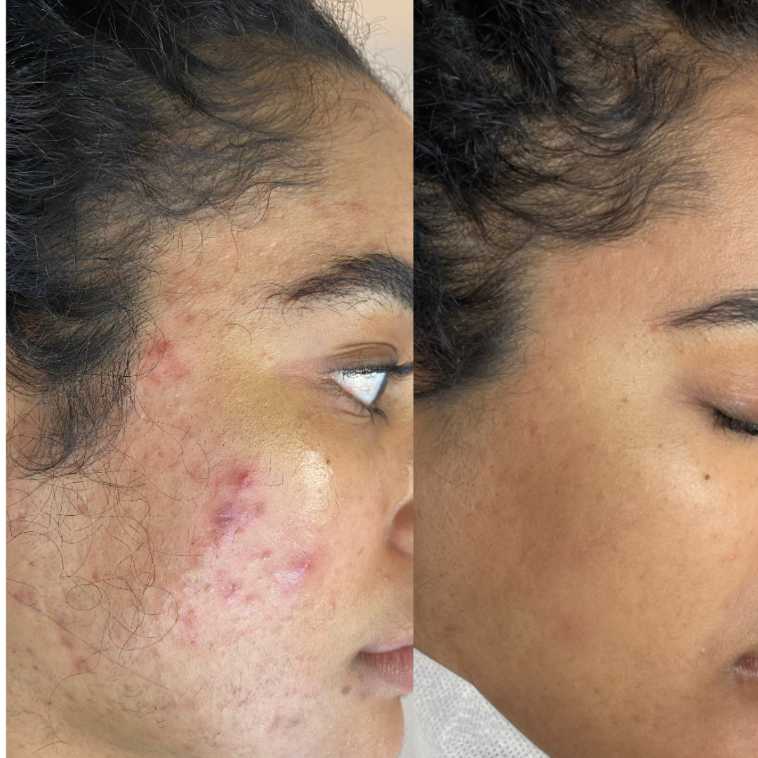 Sensitive Skin Acne Spot Cream
